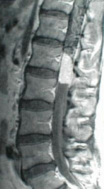 This is a sagittal image of an enhancing conus med