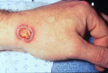Pictures of Skin Disorders [Slideshow] - LoveToKnow