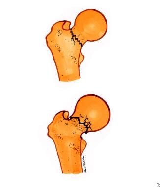 Femoral neck fractures. Top diagram is a nondispla