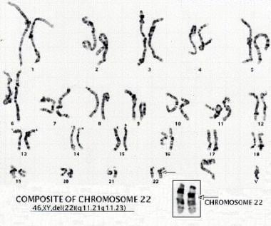 Velocardiofacial Syndrome. Karyotype of a patient 
