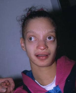 A girl with Wolf-Hirschhorn syndrome showing chara