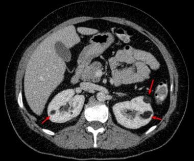 CT scan showing angiomyolipoma of kidneys. Courtes