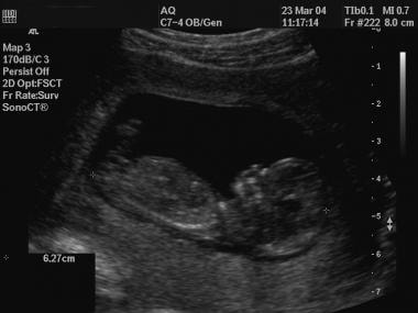 Ultrasonographic view of a fetus for a crown-rump 