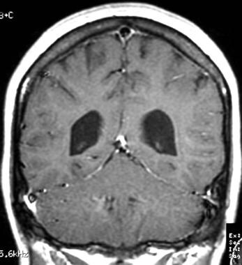 Gadolinium-enhanced, coronal, T1-weighted MRI. 