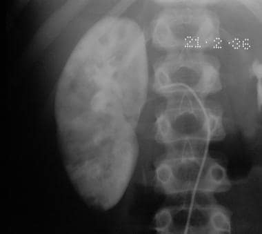 Selective right renal angiogram showing multiple a