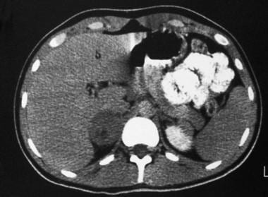 Late-phase contrast-enhanced computed tomography (