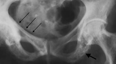 Anteroposterior radiograph of the pelvis demonstra