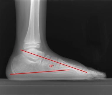 Postoperative lateral view of a clubfoot shows per