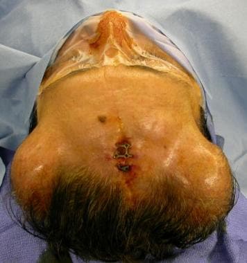 Picture of scalp before removing inflated expander