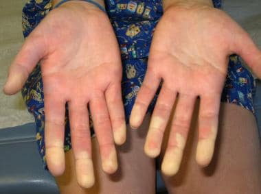Raynaud phenomenon is a common feature of mixed co