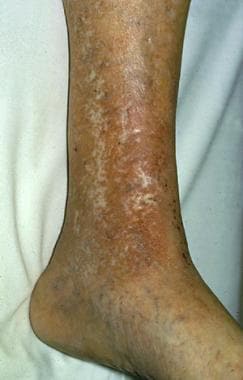 Chronic stasis dermatitis with allergic contact de