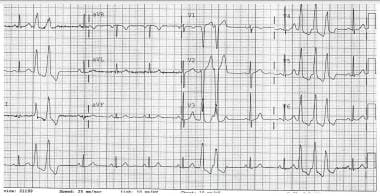 Electrical alternans. This electrocardiogram shows
