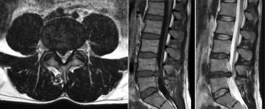 Right paracentral disk herniation at L4-5. Axial T
