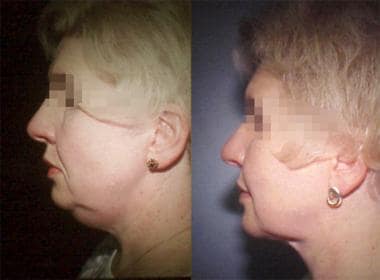 Woman aged 45 years. Left – Preoperative. Right –