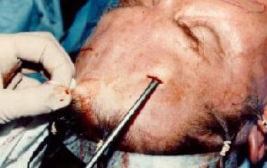 Intraoperative photograph, endoscopic brow lift su