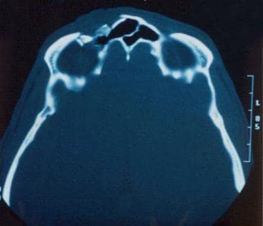 CT scan showing frontal sinus fracture with commin