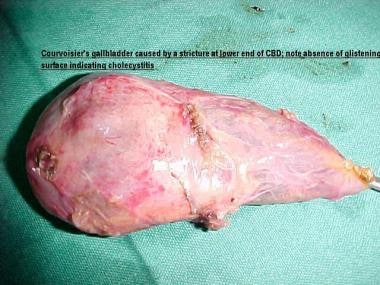 Distended gallbladder with evidence of adhesions o