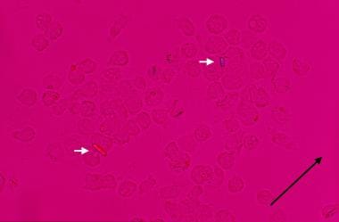 calcium pyrophosphate crystals in synovial fluid