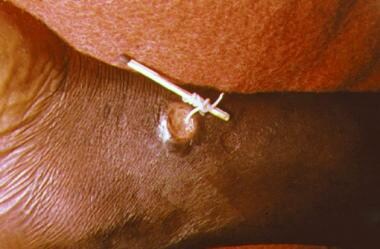 A method used to extract a guinea worm from the le
