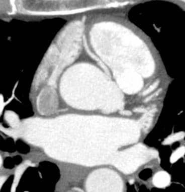Anomalous right coronary artery (RCA): Axial CT im