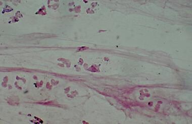 Gram stain showing Haemophilus influenzae. 