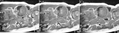 Prenatal coronal T1-weighted MRI images through th
