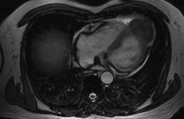 Ventricular Aneurysm Imaging: Overview, Radiography, Computed Tomography