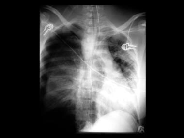 An anteroposterior radiograph from a 33-year-old m