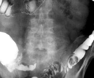 Annular carcinoma of the transverse colon is assoc