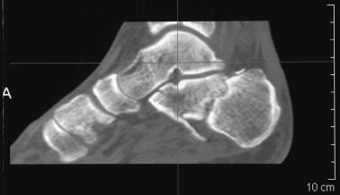 Calcaneus, fractures. Saunders type IV calcaneal f
