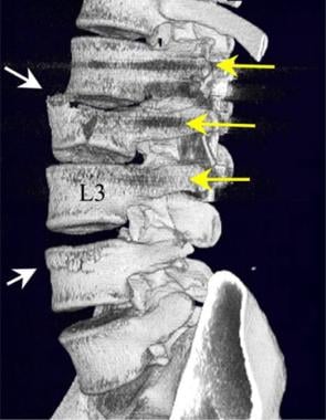 Lumbar spine trauma. Oblique view of 3-dimensional