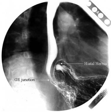 Hiatal Hernia. A paraesophageal hernia is seen on 