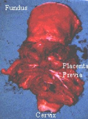Complete or total placenta previa. The entire cerv