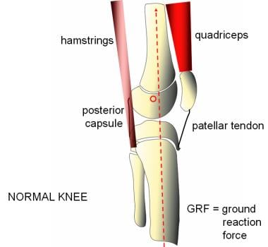 Normal sagittal alignment permits the knee to lock