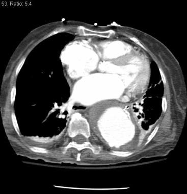 Descending thoracic aortic aneurysm with mural thr