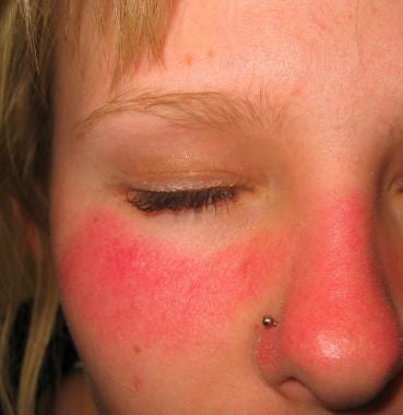 Acute sunburn of face after a soccer match in a 15