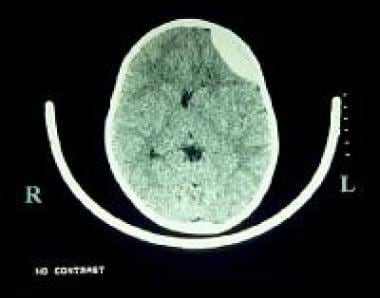 Pediatric Head Trauma. Epidural hematoma with acut