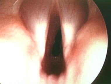 Endoscopic view of the true vocal cords in the for