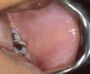 Leukoedema of the buccal mucosa. The milky-white a