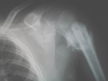 Growth plate (physeal) fractures. Healed proximal