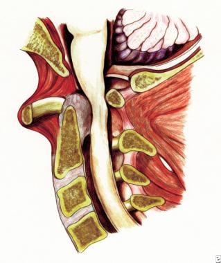 Rheumatoid spondylitis. Depiction of anterior subl