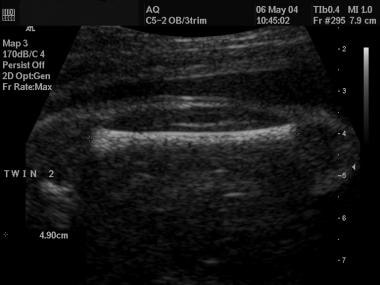 Ultrasonographic view of a fetal femur. 