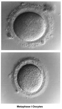 Infertility. Metaphase I oocytes. Image courtesy o