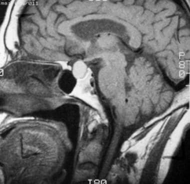 T1-weighted sagittal image obtained before contras