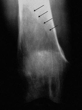 Coned down anteroposterior radiograph of the knee 