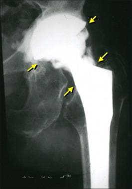 Hip arthrogram from a patient who had a total hip 
