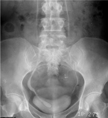 Excretory urogram demonstrates the classic cobra-h