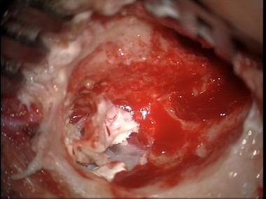 Advanced cholesteatoma with exposure of posterior 