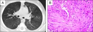 Bronchiolitis obliterans. (A) Chest CT scanning fr