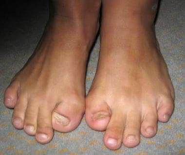 Characteristic malformed great toes and hallux val